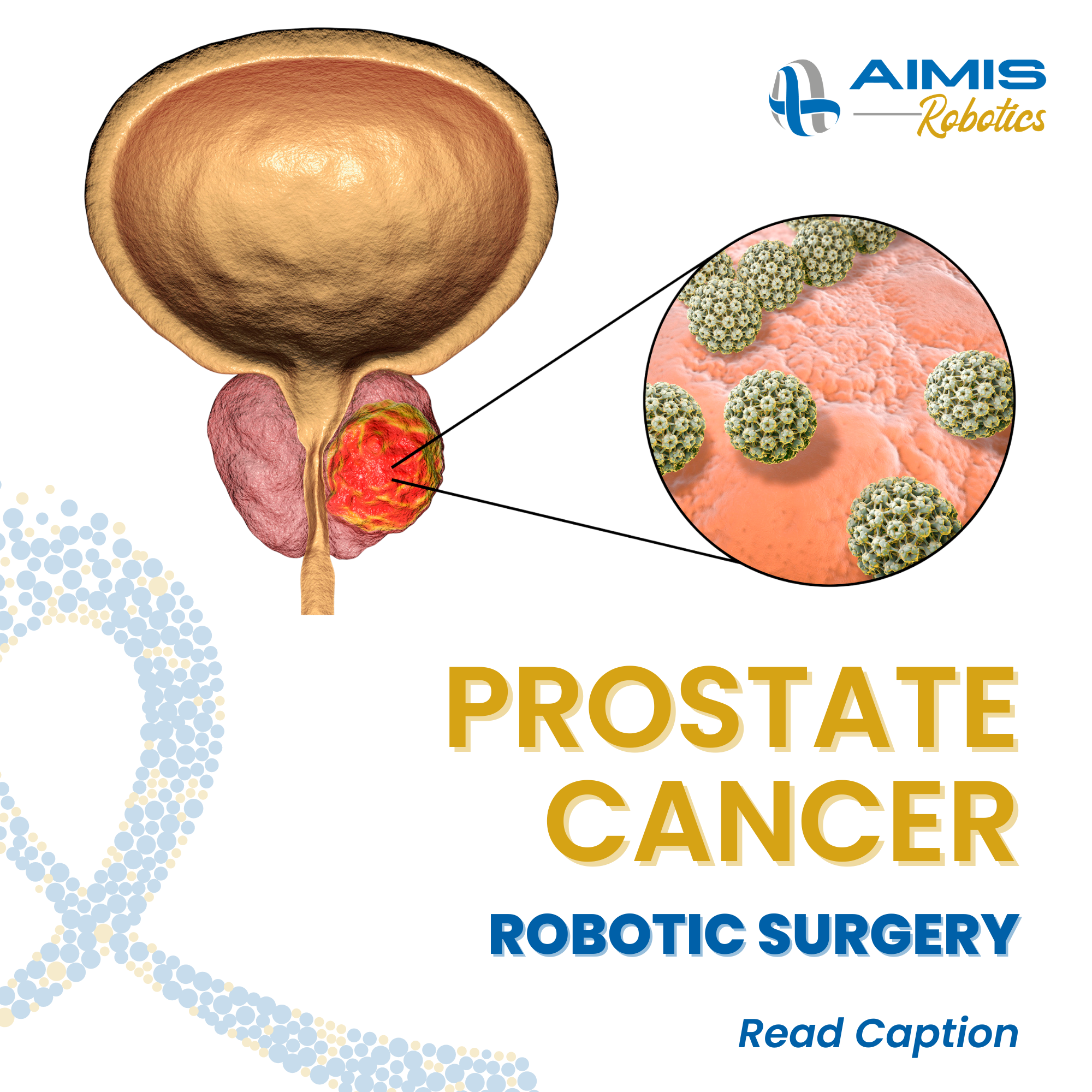 Robotic surgery for Prostate Cancer